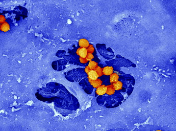 Predicting mortality from S. aureus bacteraemia.