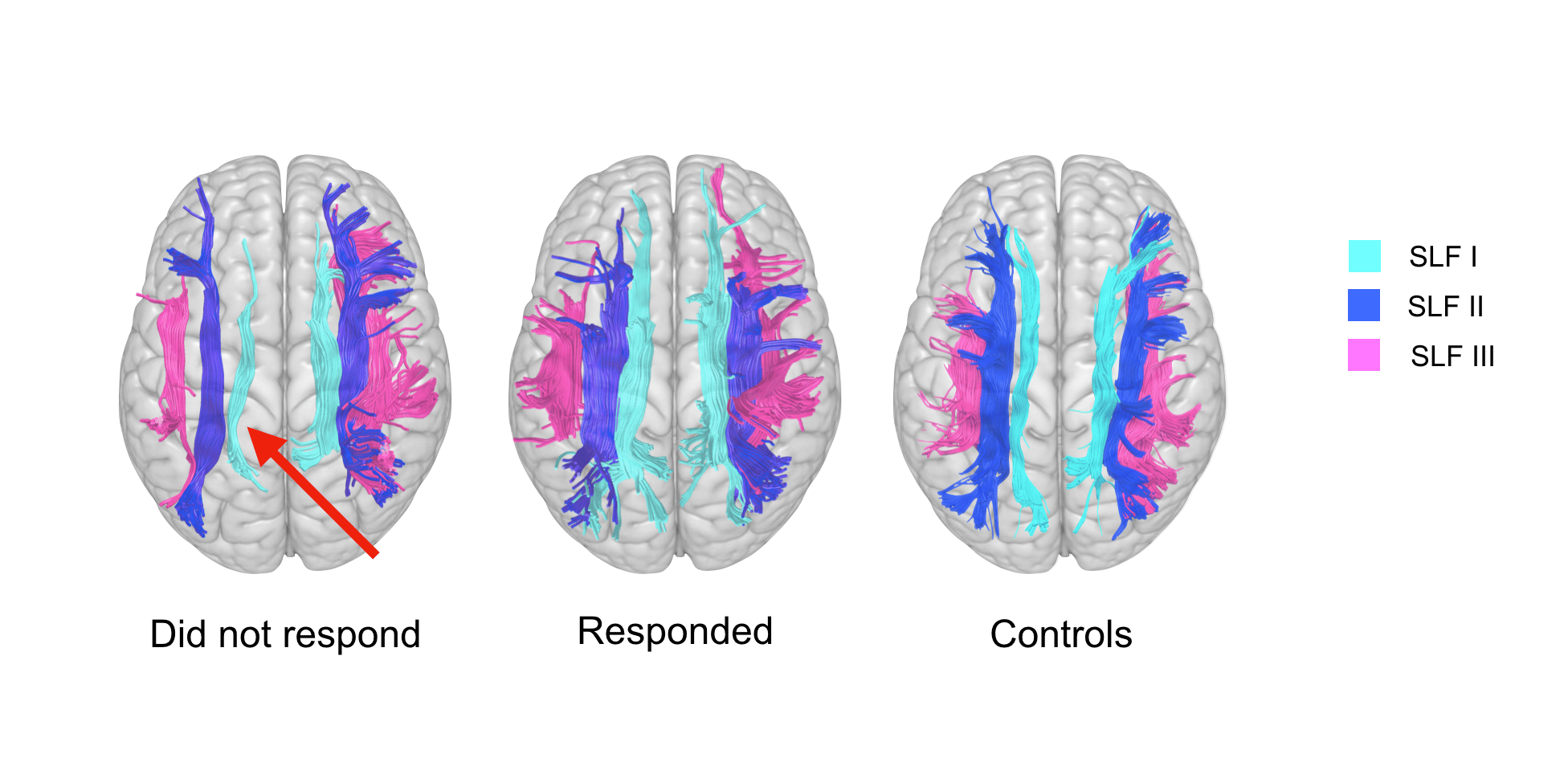 POOR RESPONSE TO METHYLPHENIDATE IS ASSOCIATED WITH A SMALLER DORSAL ATTENTIVE NETWORK IN ADULT ATTENTION-DEFICIT/HYPERACTIVITY DISORDER (ADHD).