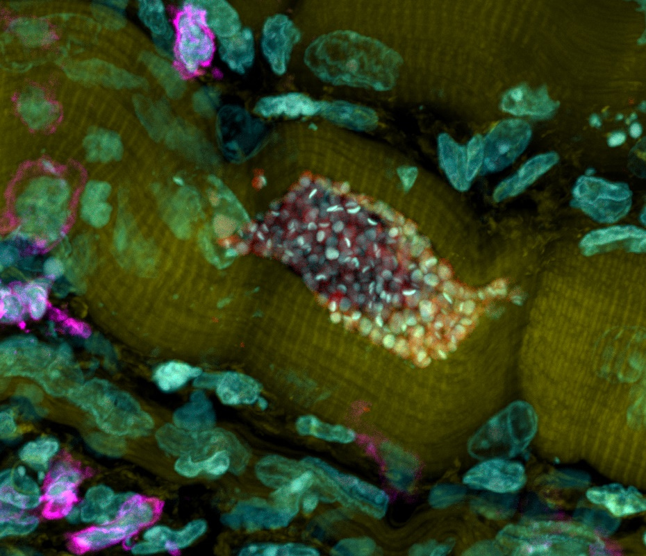 New Hope for Treatment of a Very Neglected, Neglected Tropical Disease