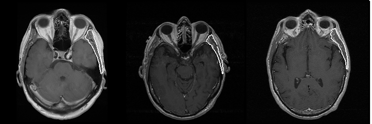 Deep learning-based quantification of temporalis muscle has prognostic value in patients with glioblastoma