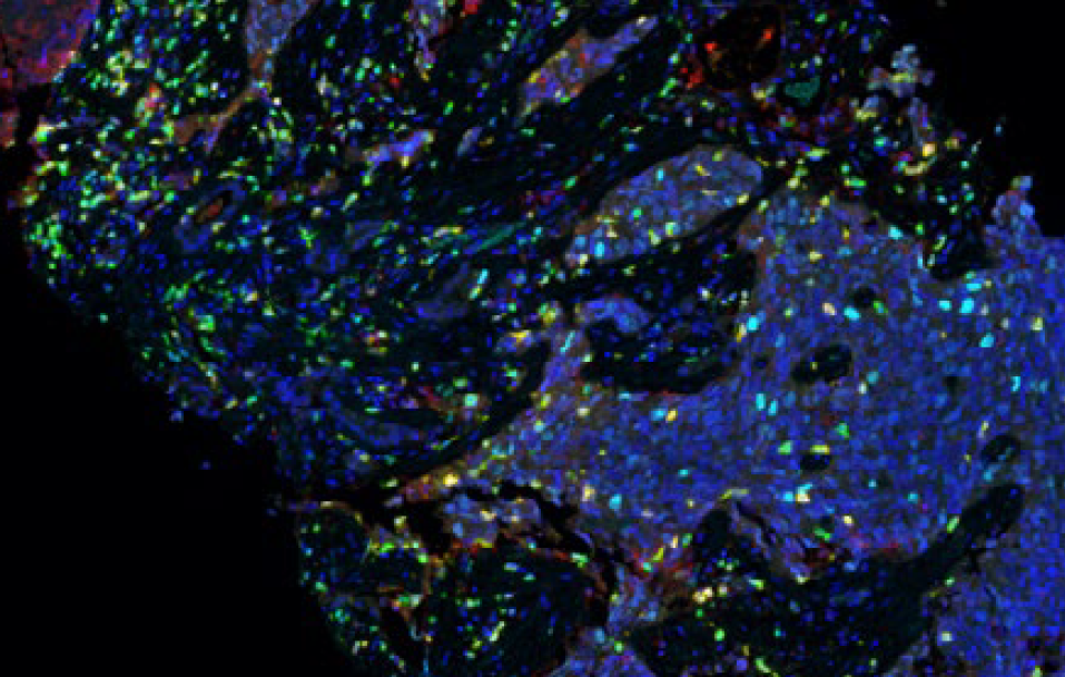 Highly aneuploid lung cancers benefit from adding radiation to immune checkpoint blockade
