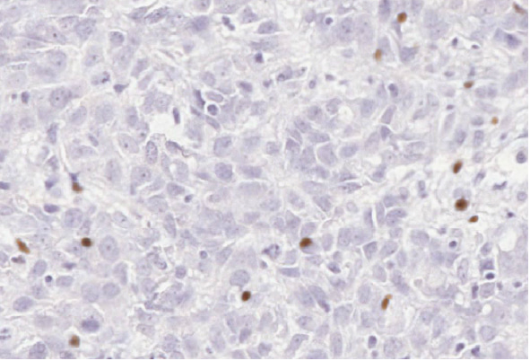 Unlocking the potential for immune checkpoint inhibitors in Metaplastic Breast Cancers.