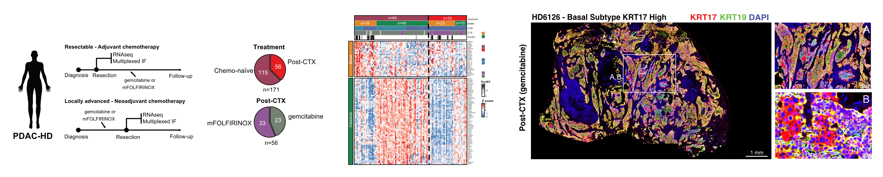 Persister cell phenotypes contribute to poor patient outcomes after neoadjuvant chemotherapy in PDAC