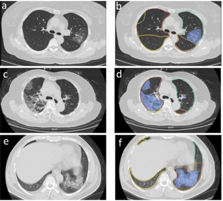 Quantitative imaging in combination with clinical & lab data risk stratifies COVID19 patients