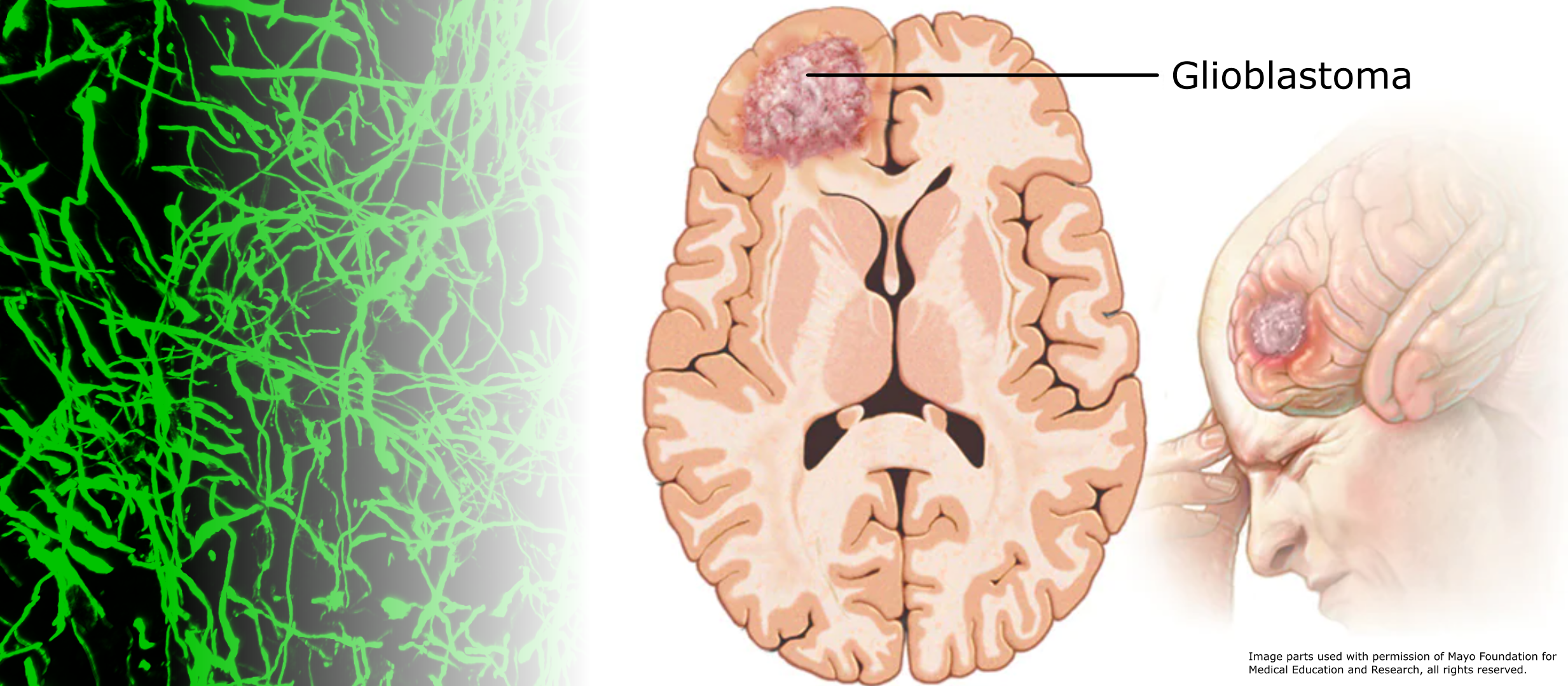 A connectivity signature for glioblastoma – towards a molecular and phenotypical understanding of the deadliest brain tumor in adults