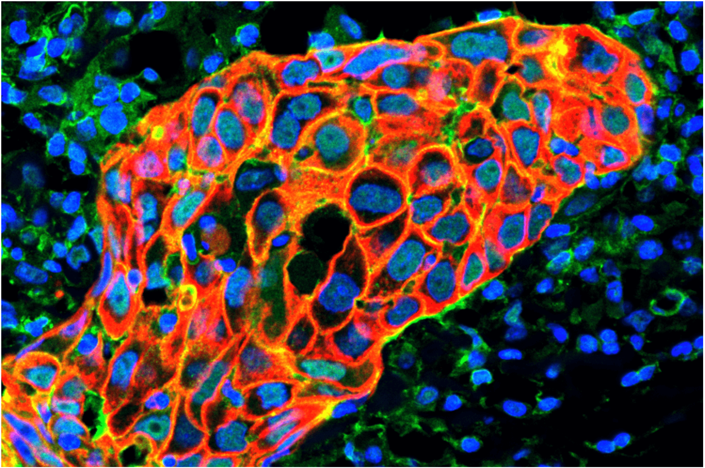 RAGE drives cell plasticity in metastatic TNBC