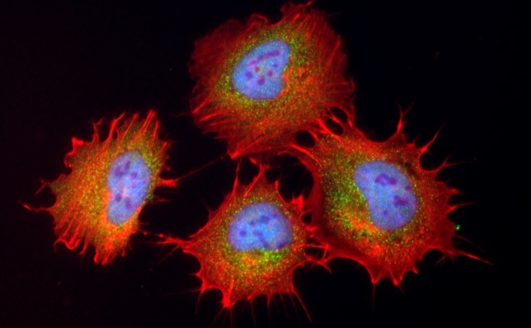 Targeting Metastatic Ewing Sarcoma via YAP/TAZ Inhibition