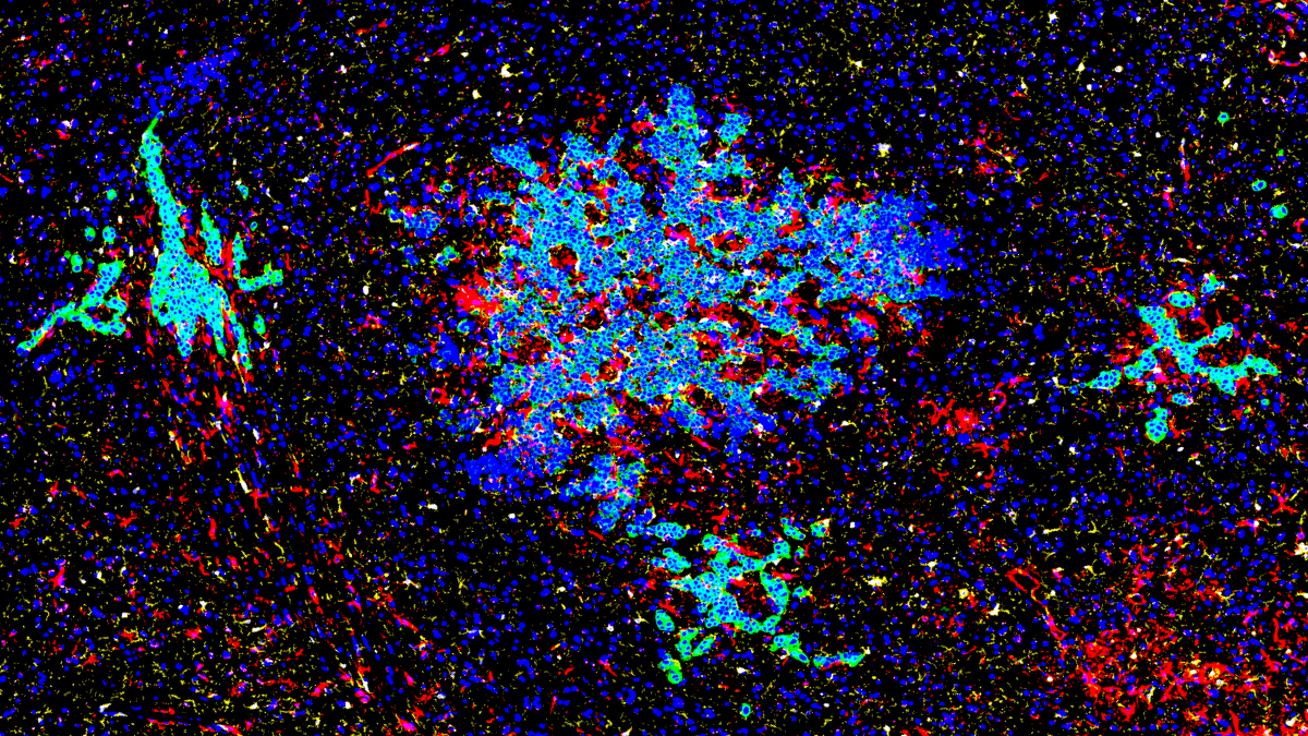 Rethinking ER+ Breast Cancer Brain Metastasis: From Clinical Observation to Biological Insight