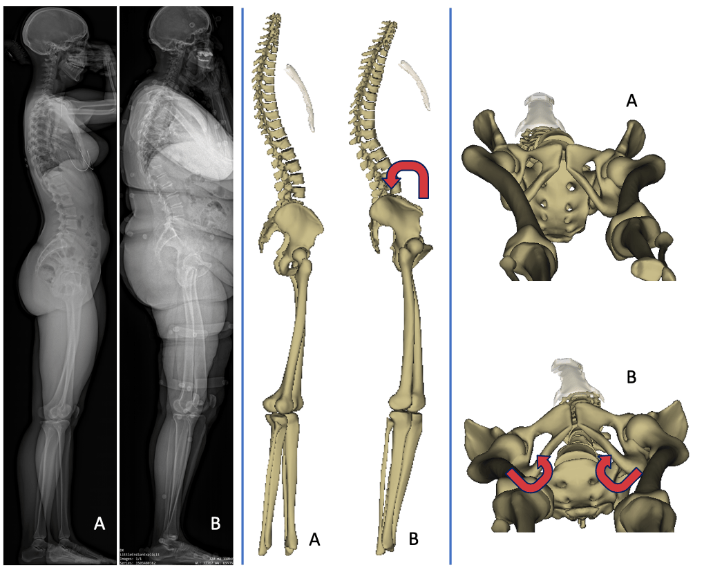 Femoral neck version in the spinopelvic and lower limb 3D alignment: a full-body EOS® study in 400 healthy subjects