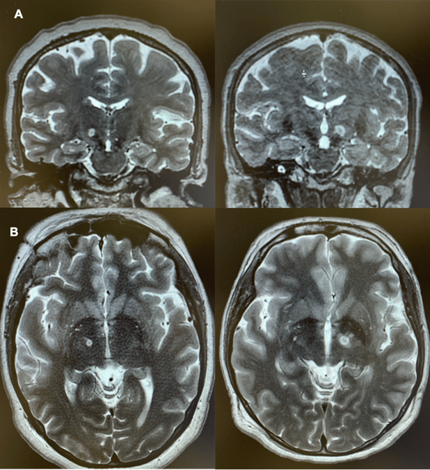 Advancing Parkinson's Treatment through MRgFUS Subthalamotomy