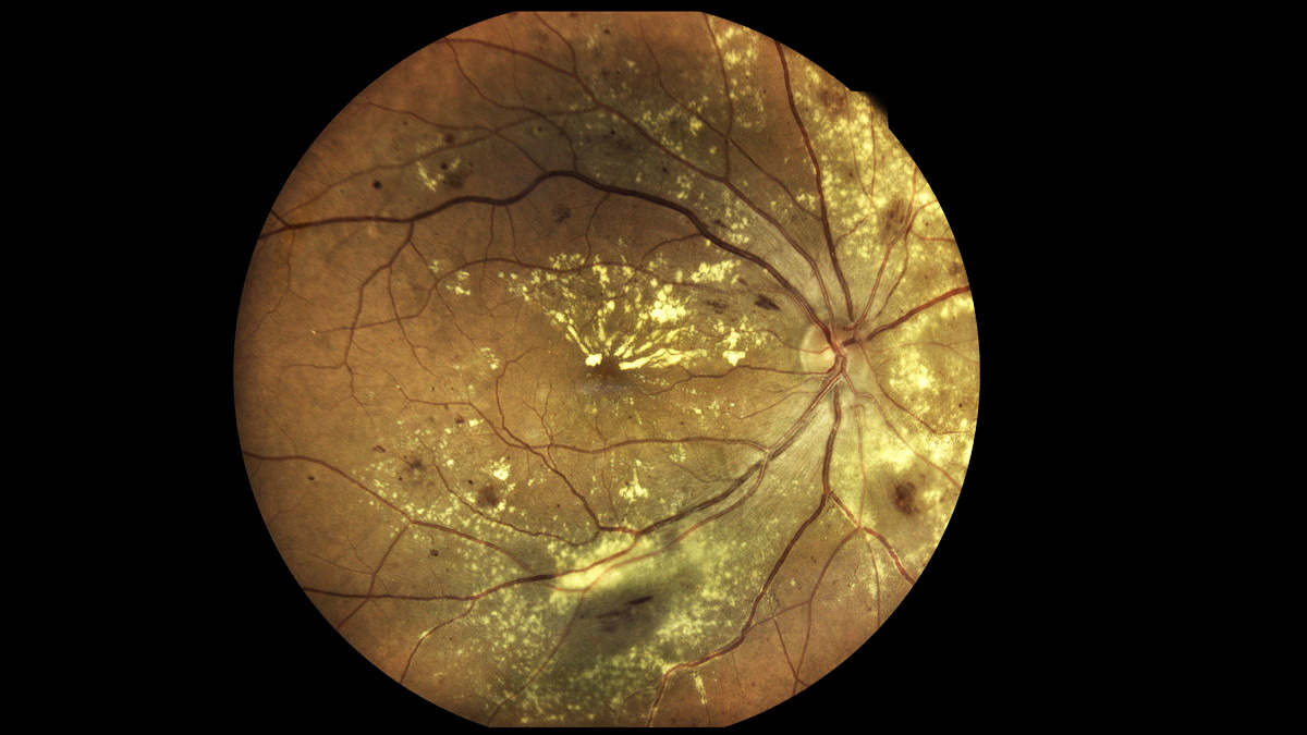 Your space to connect: The Macular degeneration Hub  