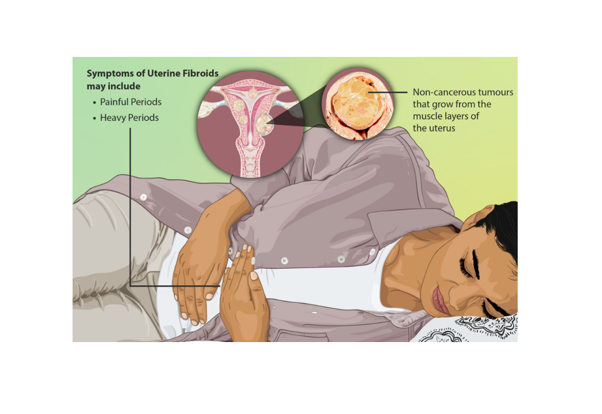 Fibroids: The Research Behind the Disparity