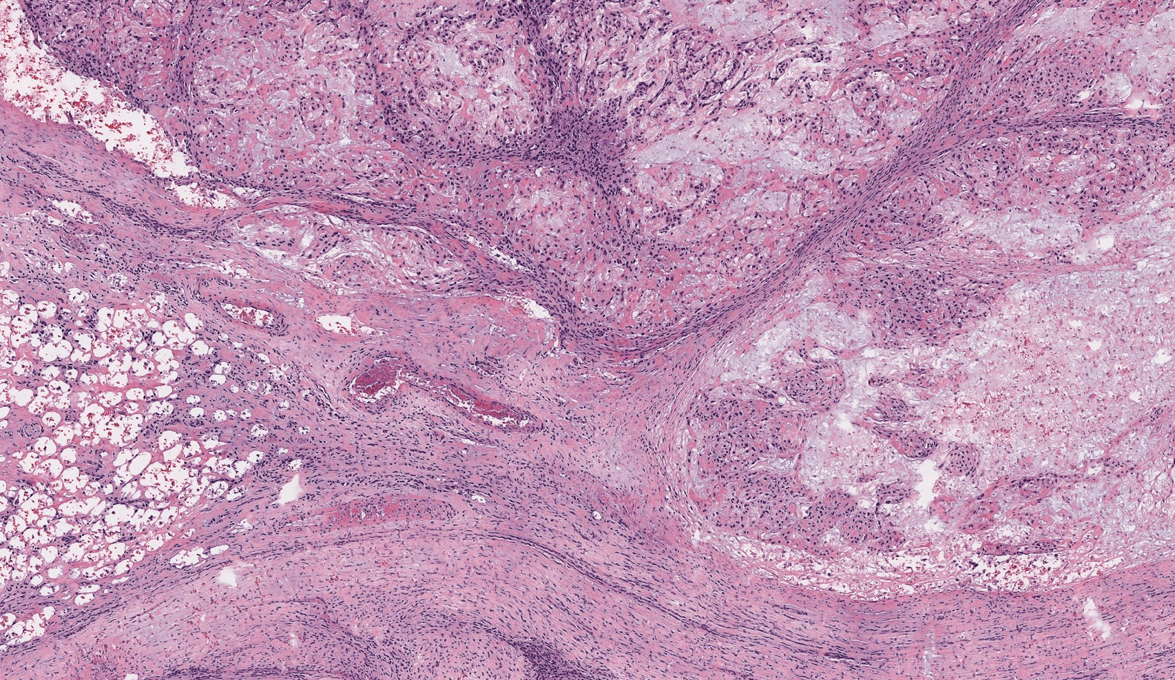 Label-free photoacoustic histology for intraoperative diagnosis of bone
