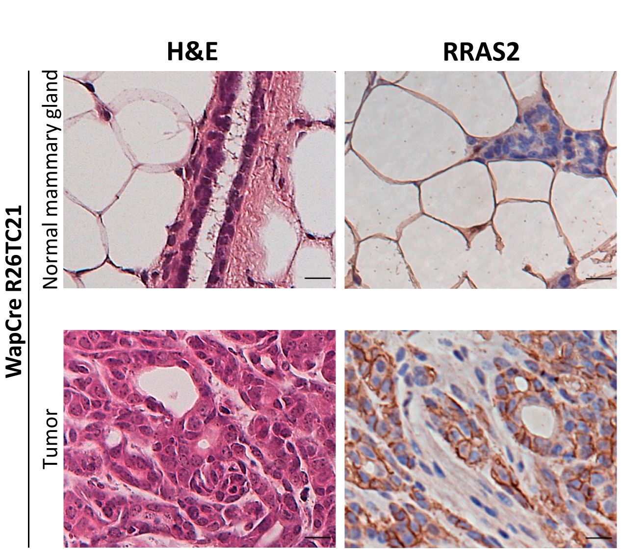 Unmutated RRAS2 Emerges as a Key Oncogene in Post-partum-associated Triple Negative Breast Cancer