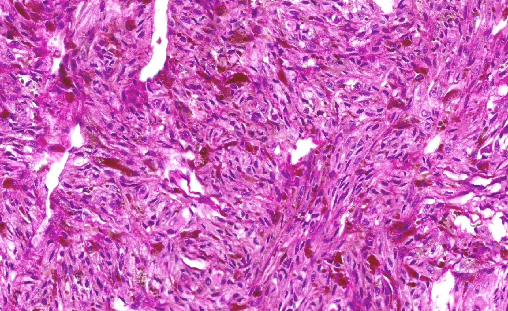 The long-term prognosis in uveal melanoma may be better than expected