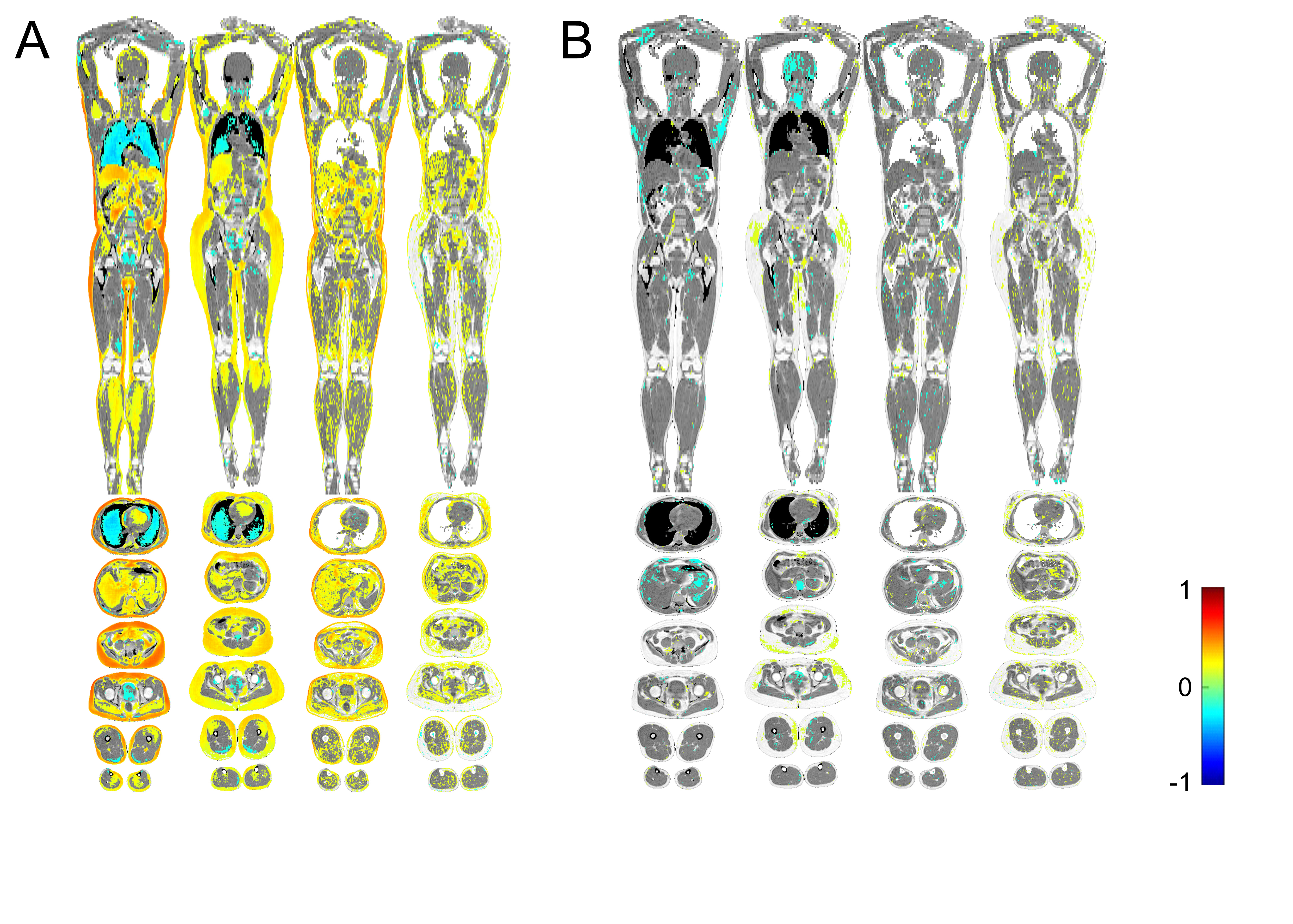 Metabolic profiling of galectin-1 and galectin-3: a cross-sectional, multi-omics, association study
