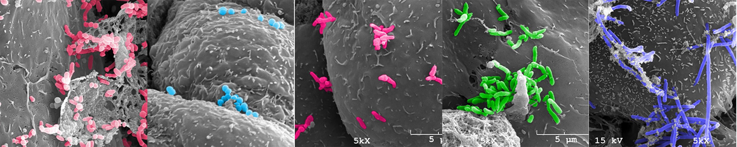 Leveraging 3-D models and immunometabolic profiling to understand how vaginal bacteria may promote cancer development