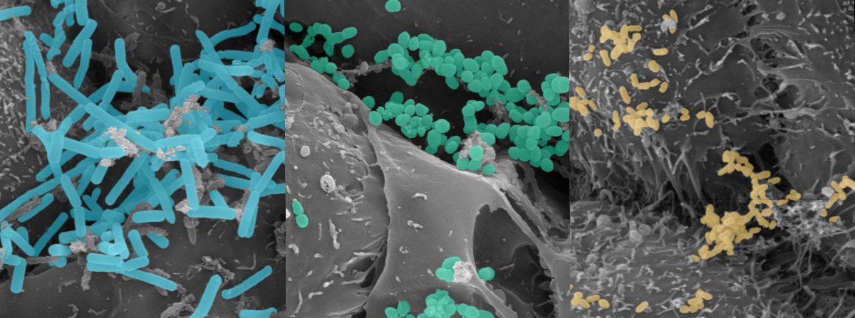 The power of 3D tissue models and omics technologies for studying bacterial vaginosis and the functional impact of the vaginal microbiome