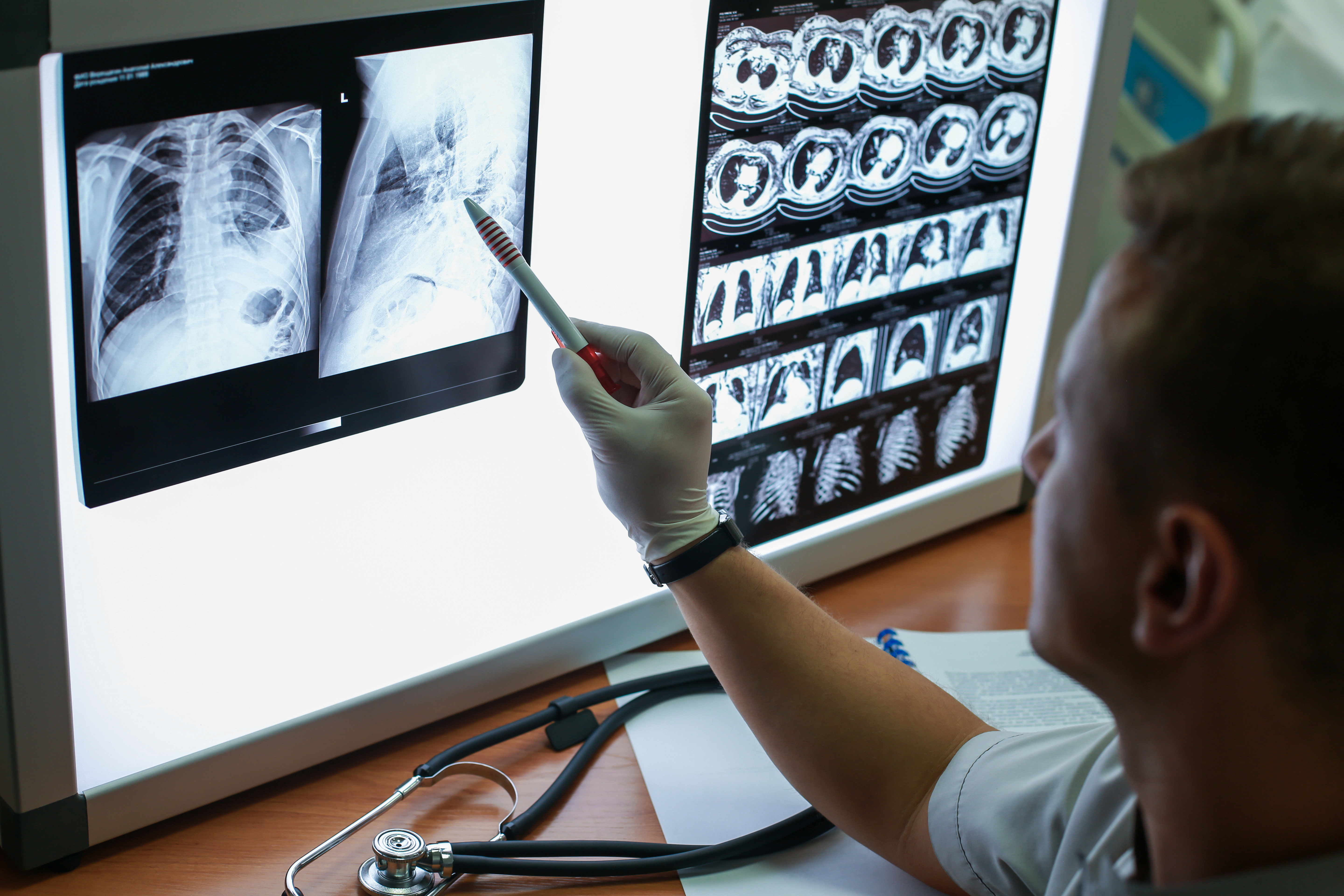 Call for Papers: Innovations in Rib Fracture Management