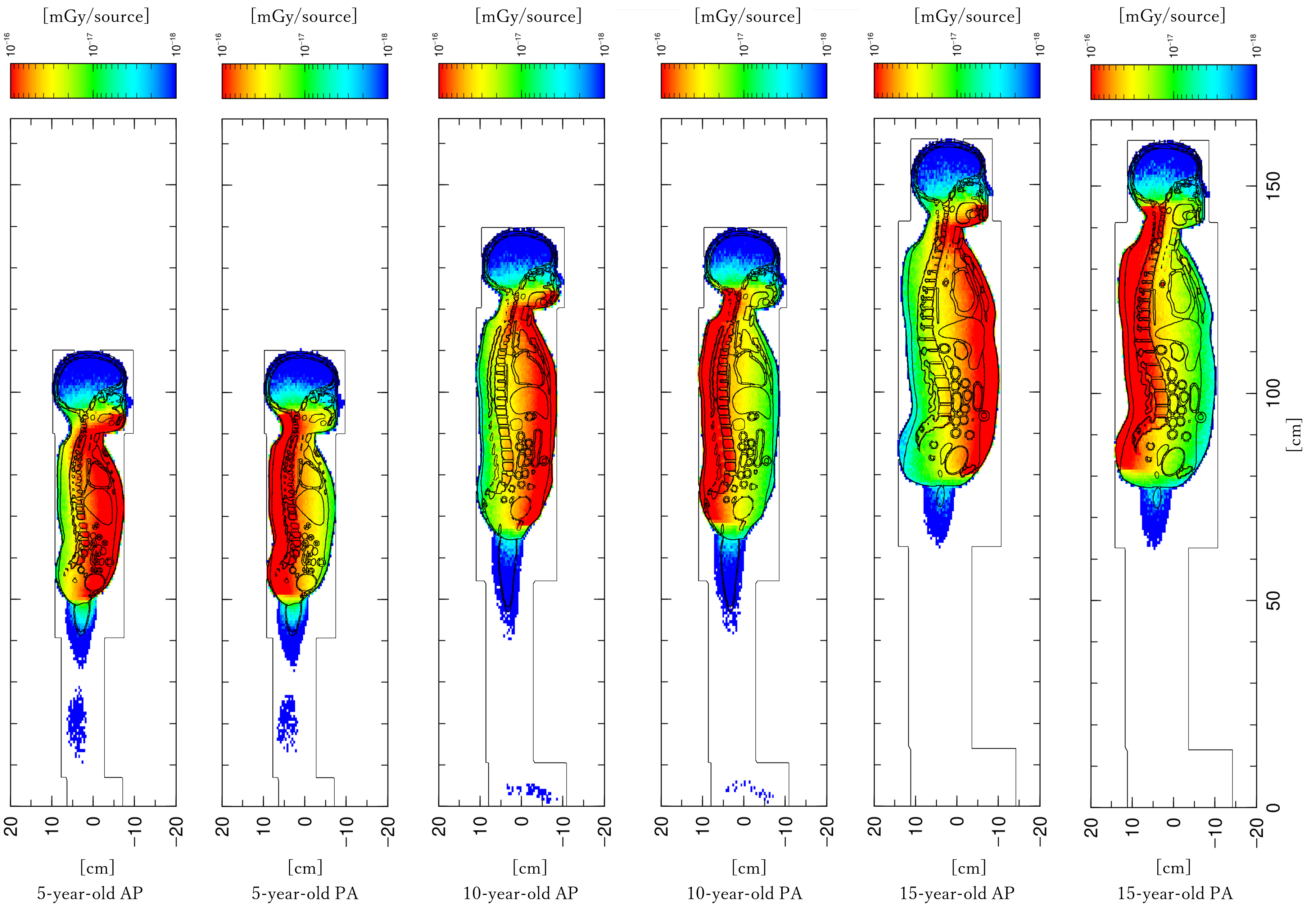 Why projection direction matters in pediatric full-spine radiography