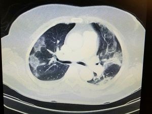 Call for papers: Connective tissue disease-associated interstitial lung disease