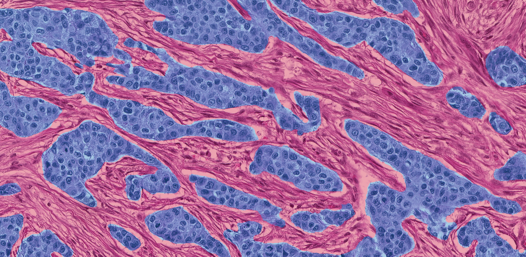 The Hypoxome of the Tumor Microenvironment 