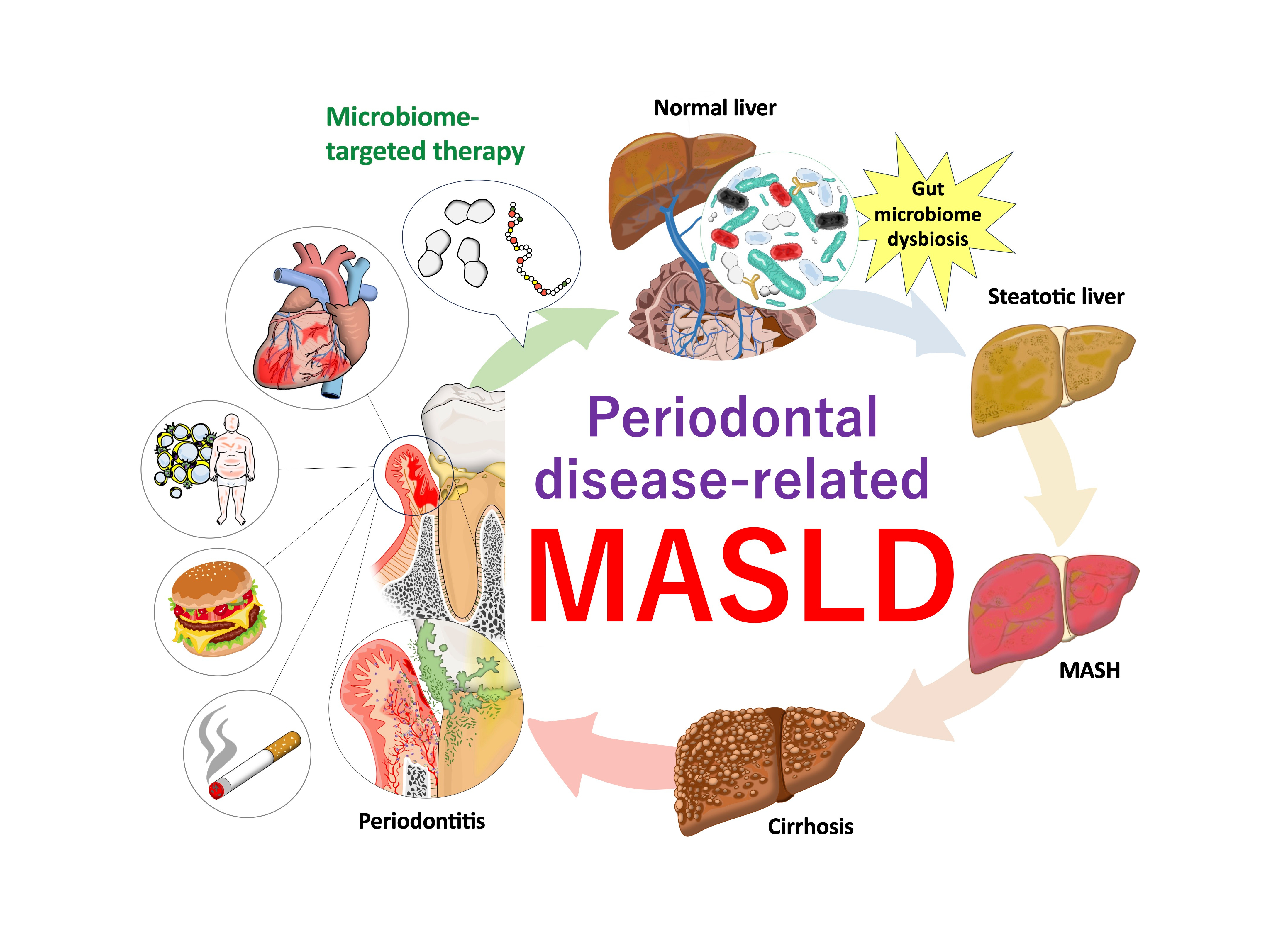 Potential disease definition of periodontal disease-related-MASLD/MASH and microbiome-targeted therapy via the oral-gut-liver axis 