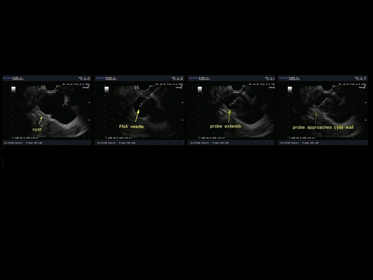 Light scattering spectroscopy identifies cysts with early pancreatic cancer