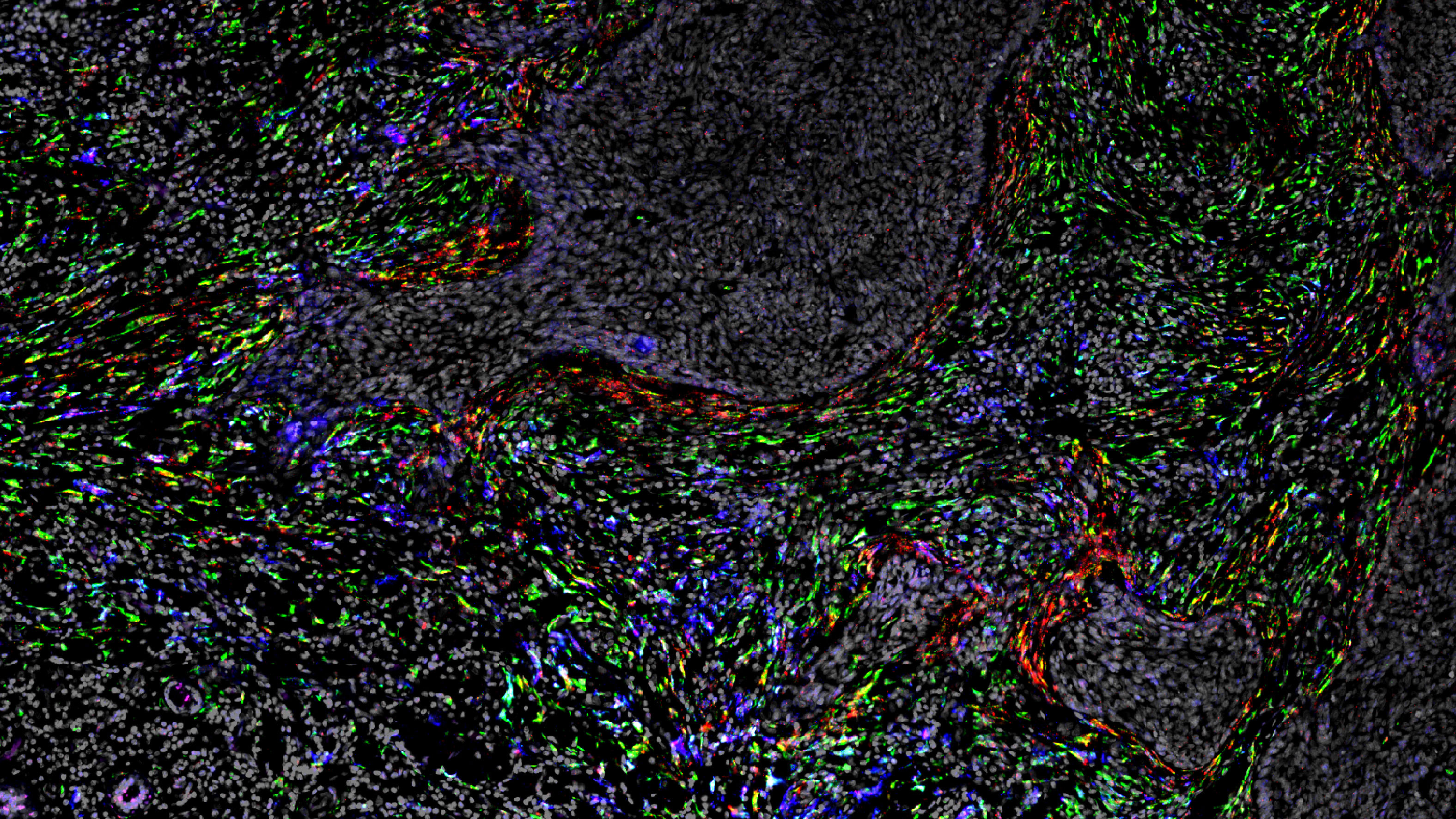 From Benign to Malignant: How iCAFs Shape the Skin Cancer Landscape