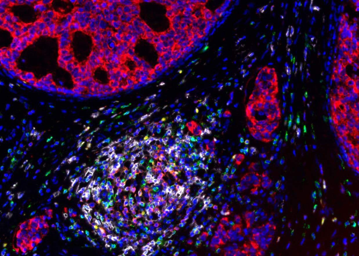 Identification of novel immune biomarker in TNBC