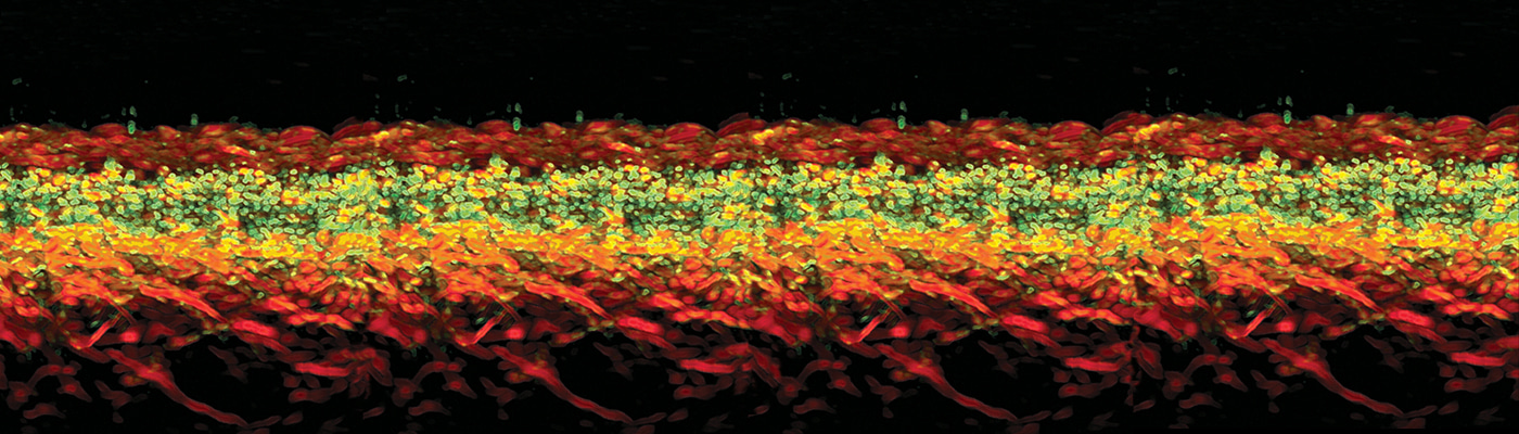 Ultra-broadband photoacoustic imaging of label-free psoriasis biomarkers