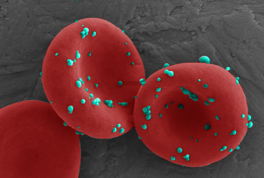 An erythrocyte mediated immunotherapy to leverage lung metastasis for cancer immunization