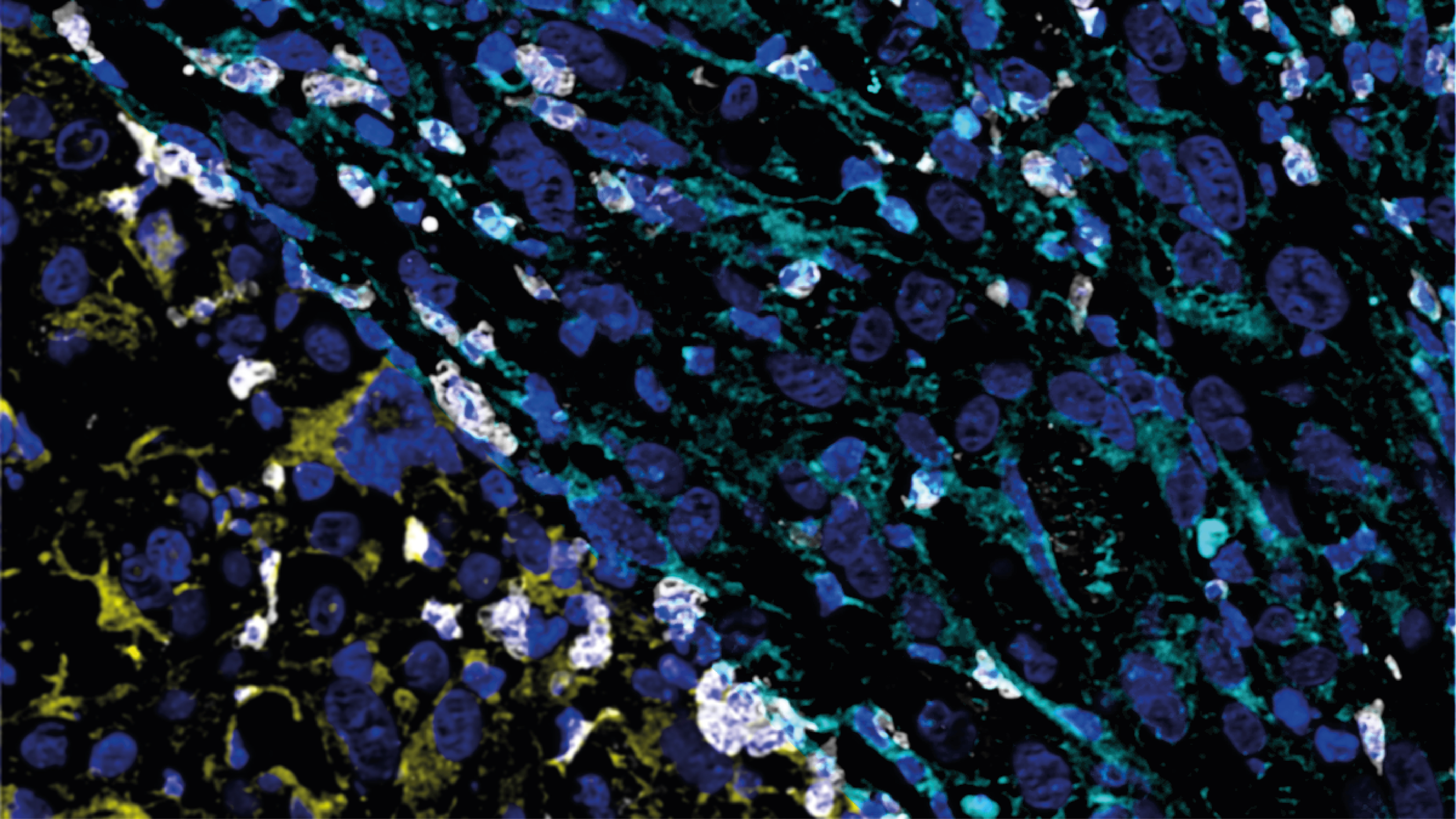 Proton boron capture therapy (PBCT) in glioblastoma model