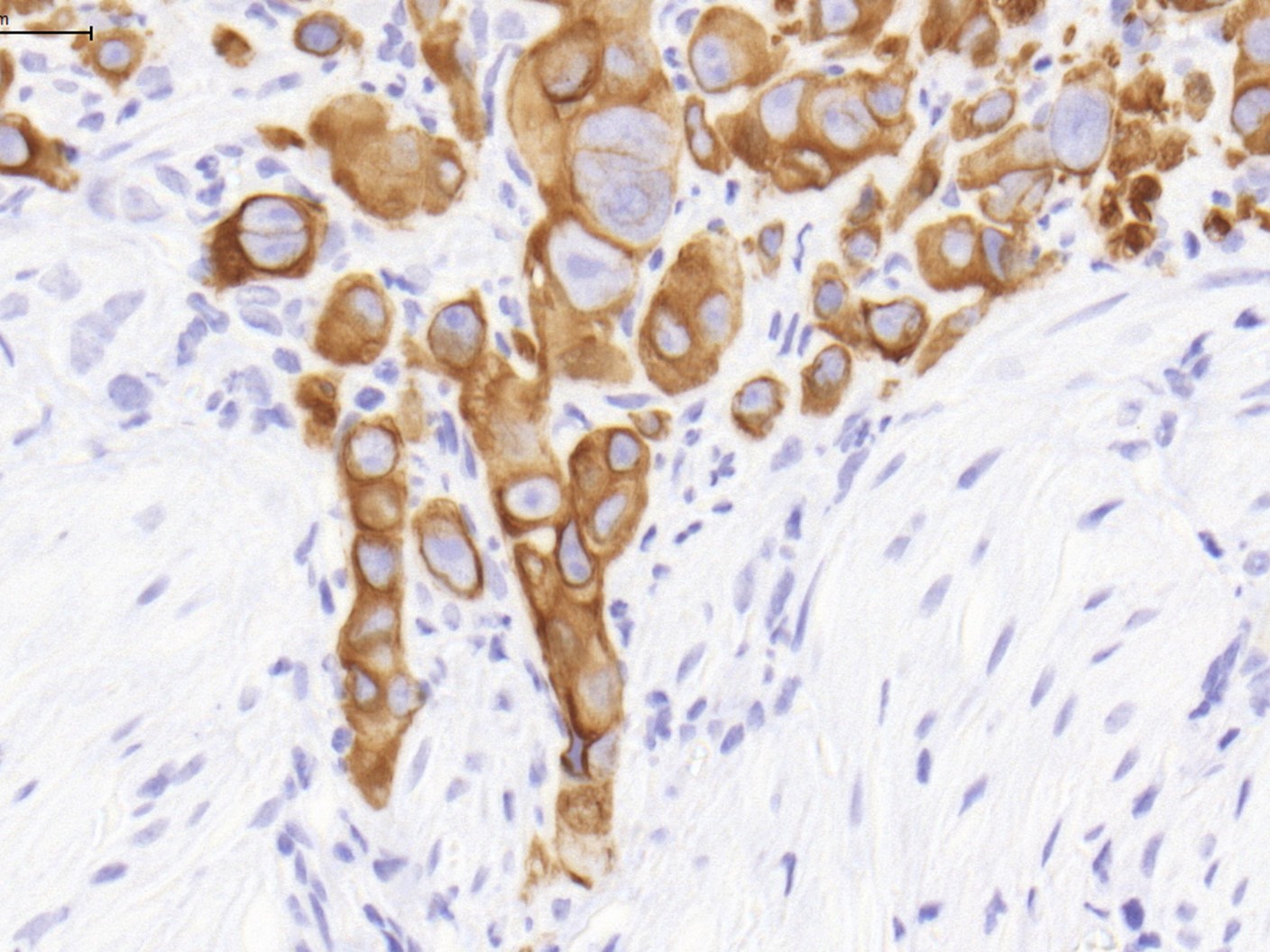 Modeling the Invasive Progression of Human Cancer