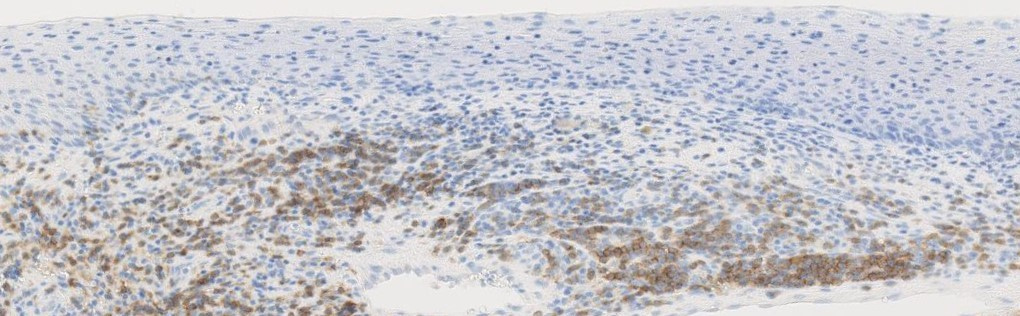 The Role of the Adaptive Immune Response in Cervical Carcinogenesis 