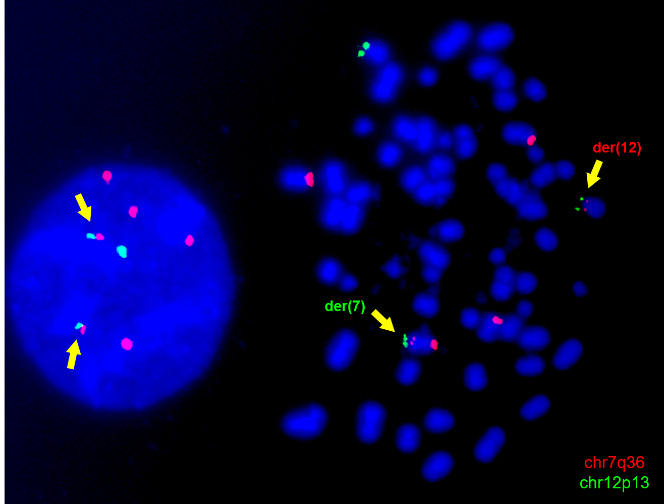 Engineering of chromosomal translocations to understand infant leukaemia