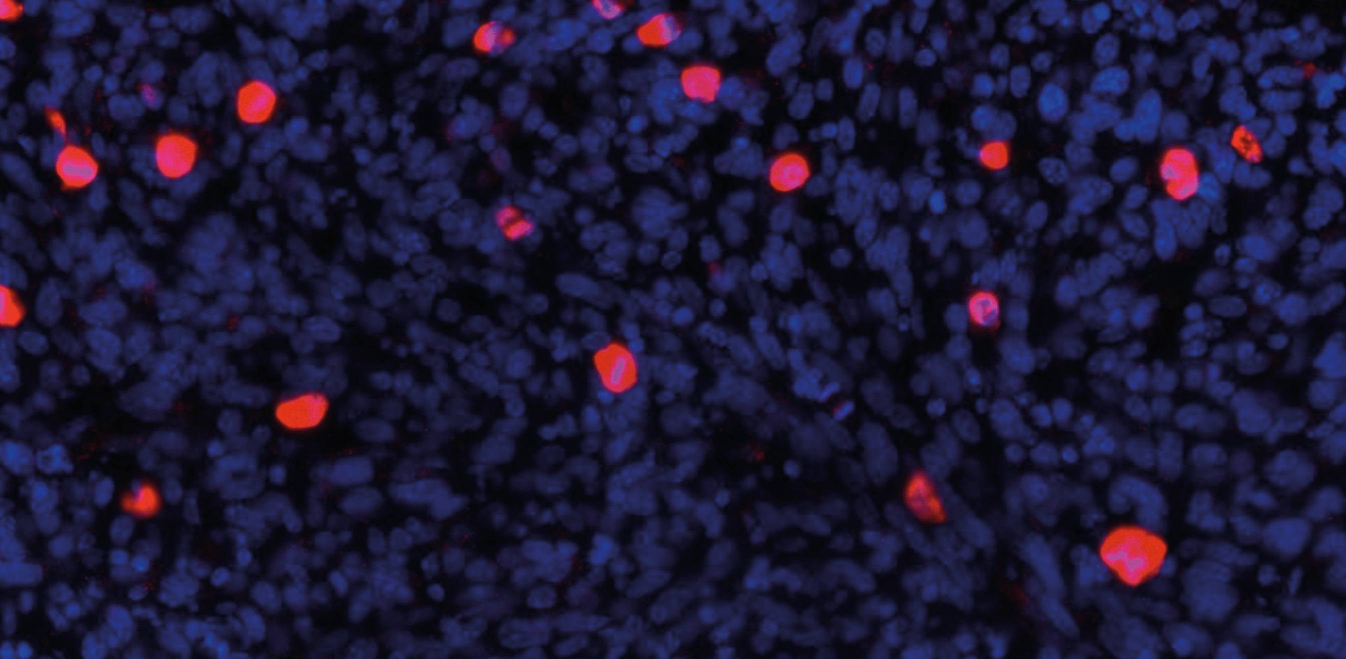 From chemotherapy resistance to immune escape: the evolving story of NCOR2