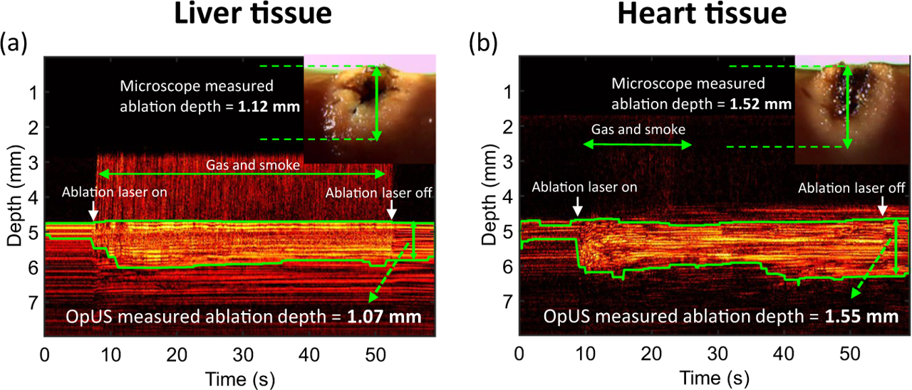 Highly miniaturised all-optical guidance of surgical laser ablation