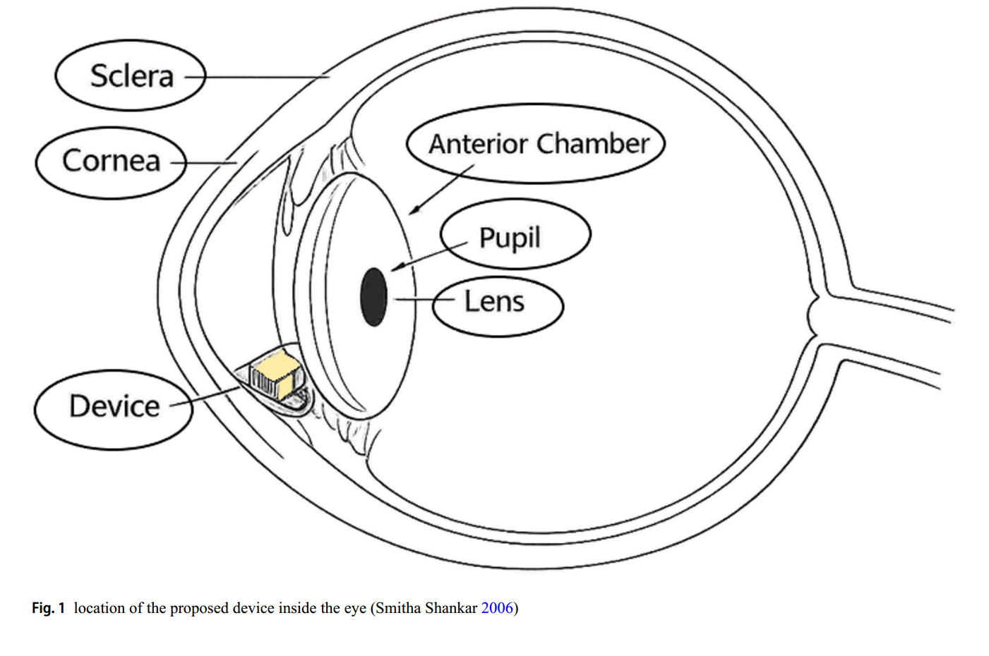 From a Classroom Idea to an Optimized MEMS Design for Glaucoma Monitoring