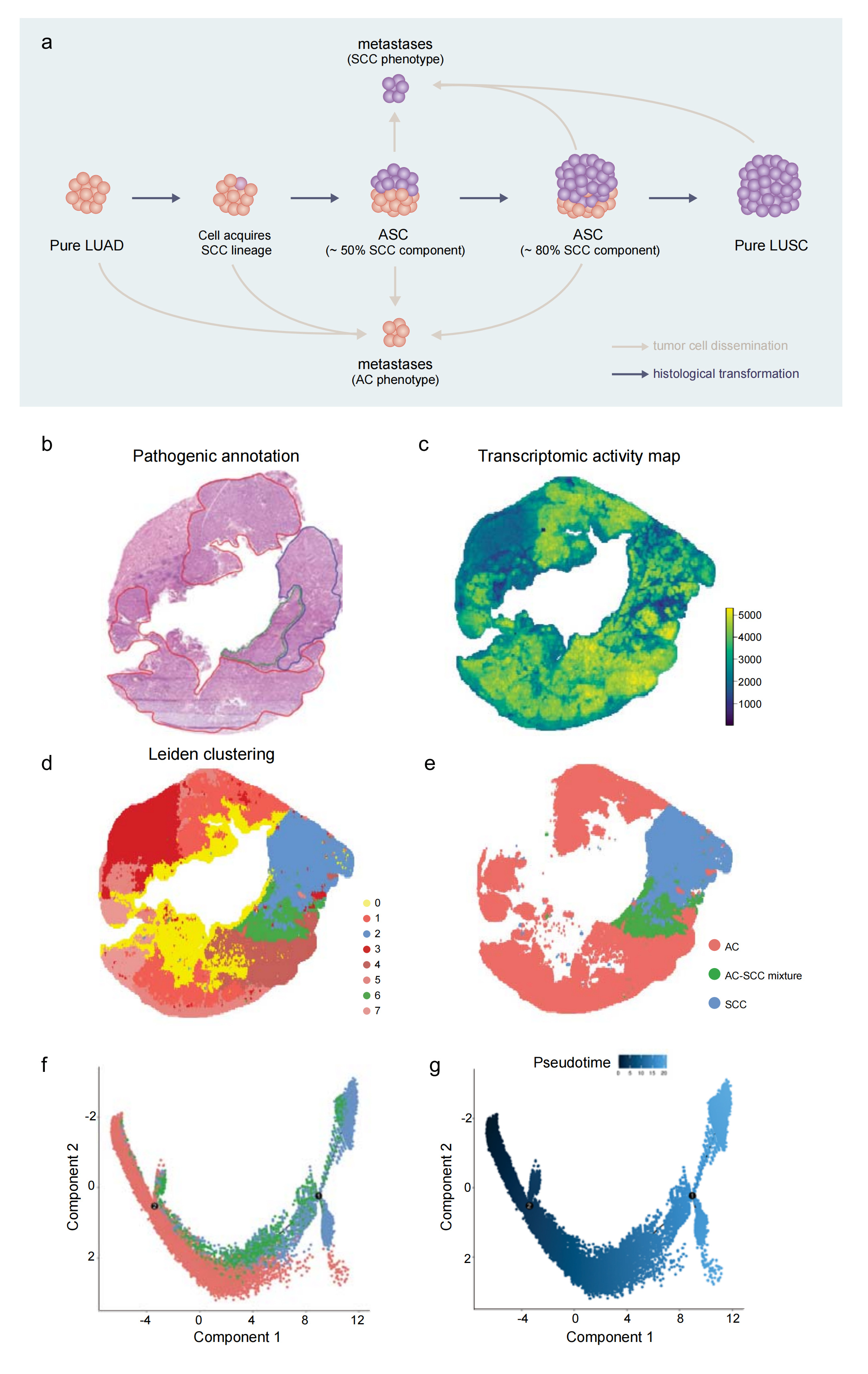 Clonal dynamics and stereo-seq resolve origin and phenotypic plasticity of adenosquamous carcinoma