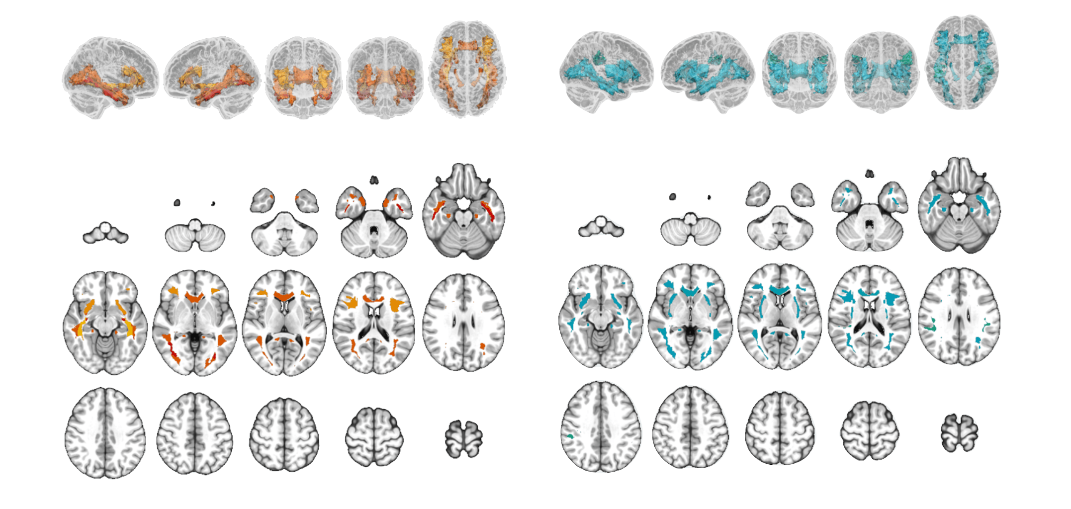 Influences of amyloid-β and tau on white matter neurite alterations in dementia with Lewy bodies