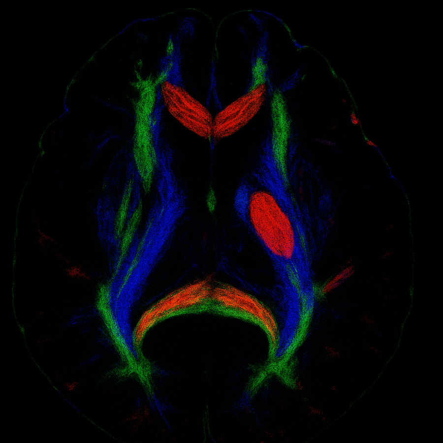 TSR Exchange — MCC950 in Aging Stroke