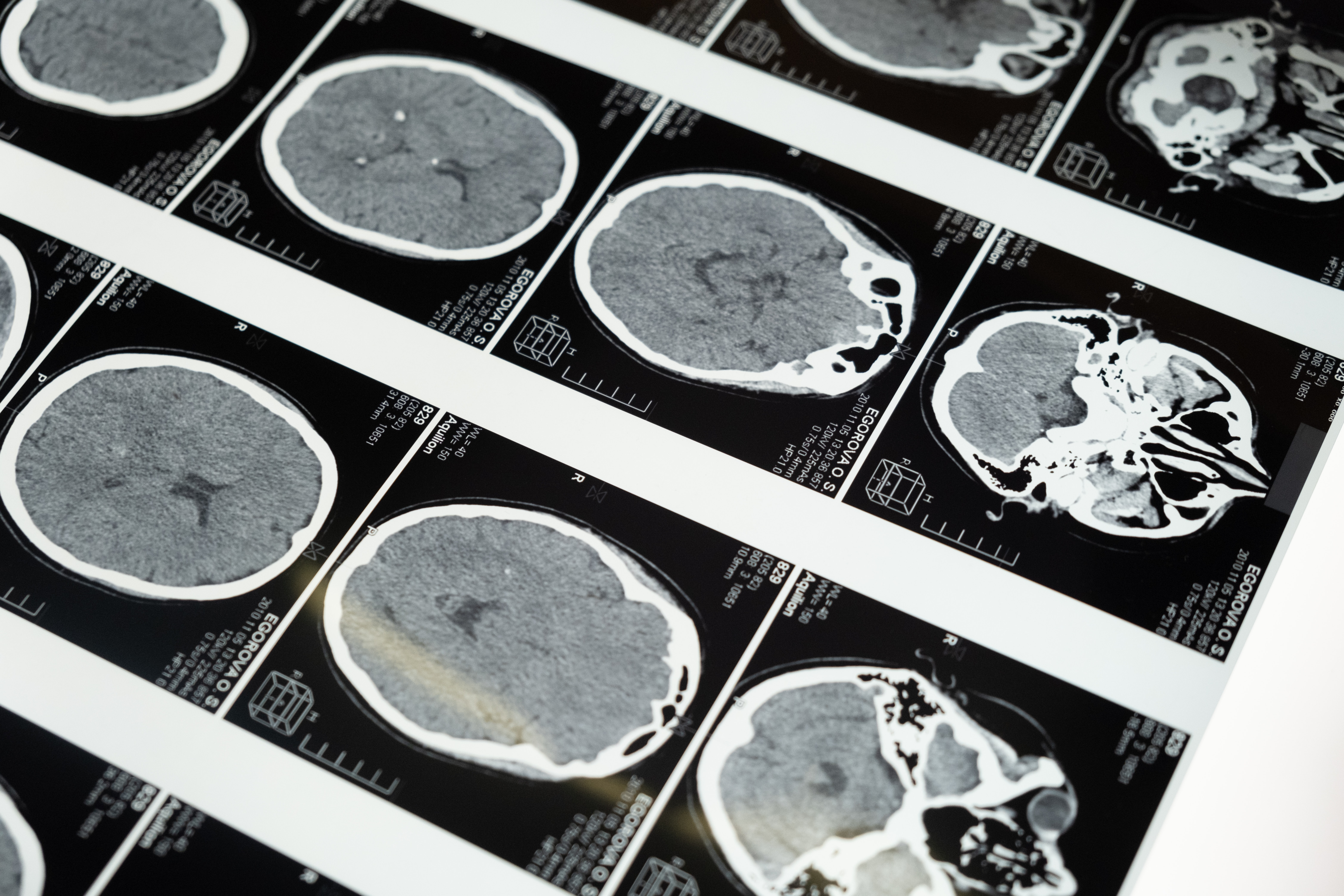 Studying the brain in adolescent early onset psychosis